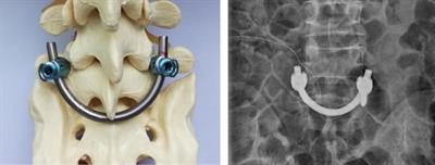 Comparison of the smiley face rod method versus intervertebral fusion for the treatment of L5 spondylolysis in adults